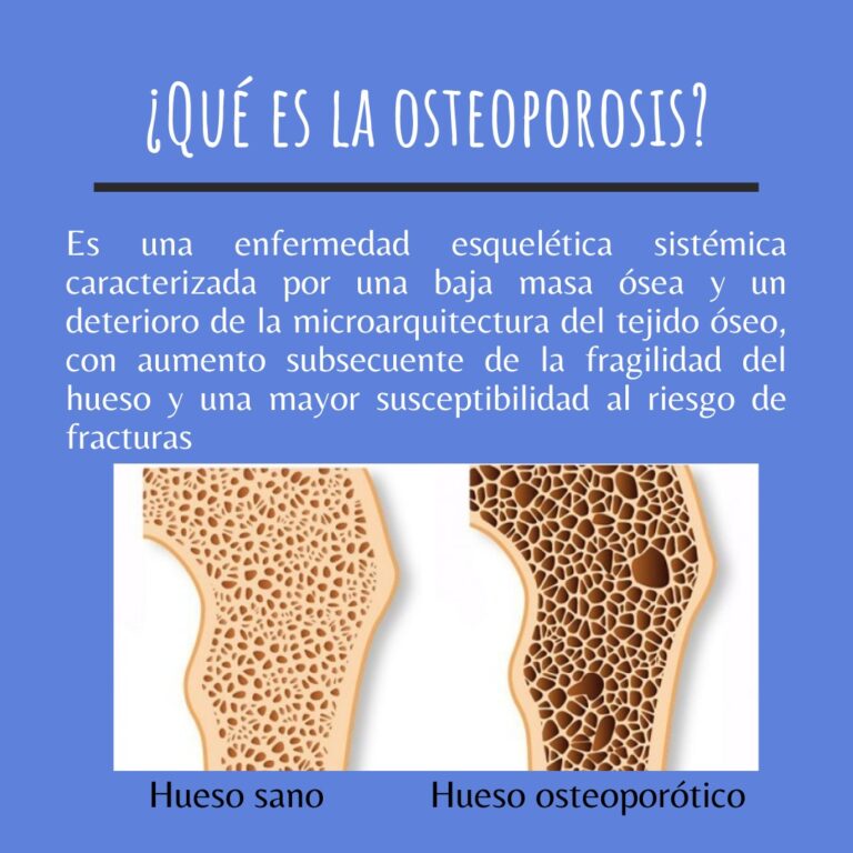 ¿Qué es la osteoporosis?